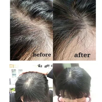 20ml Rast Vlasov Sérum Derma Pokožku hlavy Intensive Ampoule Triple Roll Masér Rýchlo Vypestujte korienky vlasov vypadávanie Vlasov Podstate Výživný E1